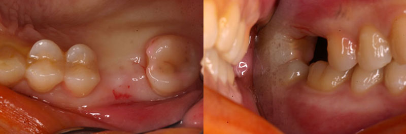 3D電腦斷層微創植牙