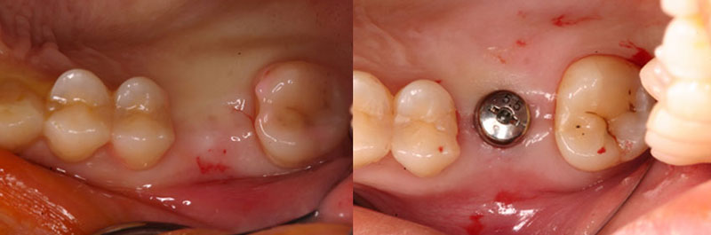 3D電腦斷層微創植牙