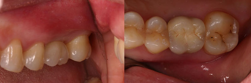 3D電腦斷層微創植牙