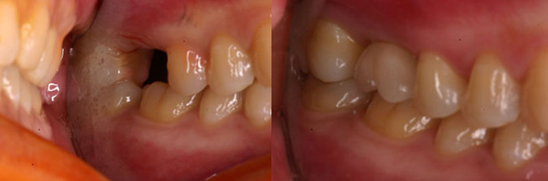 3D電腦斷層微創植牙