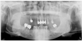 治療前X光片，多處缺牙及嚴重牙周破壞。