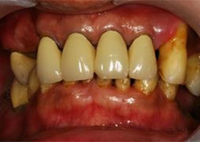 治療前，口內照片。