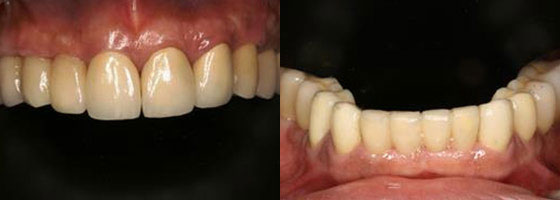 經過一年多牙周病治療與人工植牙重建病患恢復了完整的牙齒。