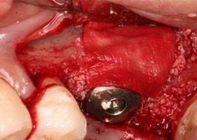 植牙合併補骨技術