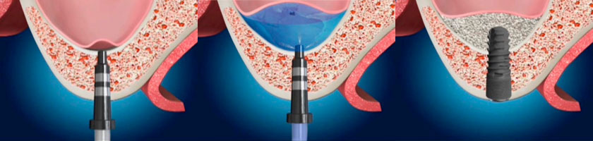 上頷竇微創增高手術