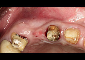 手術前可見缺牙處牙床萎縮