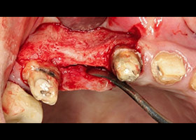 牙肉翻開後可見骨頭缺損無法植牙