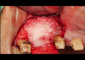 覆蓋人工骨粉與再生膜，進行補骨