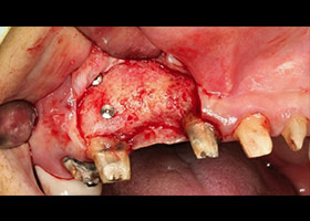 6個月後可見骨頭再生