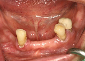 牙齒動牙須拔除