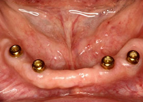 配合扣環式人工植牙