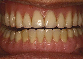 植牙與活動假牙結合